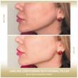 Enhance Your Facial Contours with Jawline Filler in Dubai - Dubai-Plastic surgery